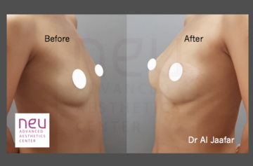 Breast fat grafting transfer Philippines before and after photos