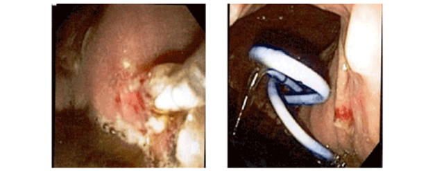 Endoscopic Ultrasound