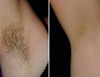 Before After photos for Laser Hair Removal Botox JuveDerm