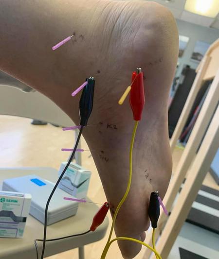 Dry Needling with Electric Stimulation, At ResultsPT, our goal is to get  you better faster. Dry needling is one of the modalities our therapist  include during treatment. This technique is part