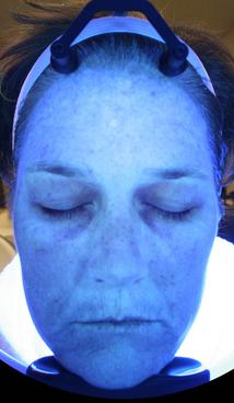 HydraFacial MD - After