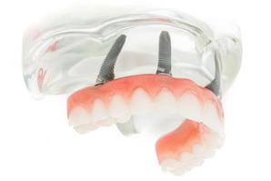 Fixed Denture On Implants Fix-On-4 Michel Puertas Denturologiste Brossard-Laprairie