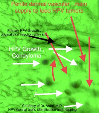 Genital warts BCR treatment , idenitification mapping