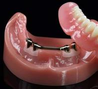 Prothèse dentaire complète du bas amovible sur 4 implants avec barre de retention Brossard-Laprairie