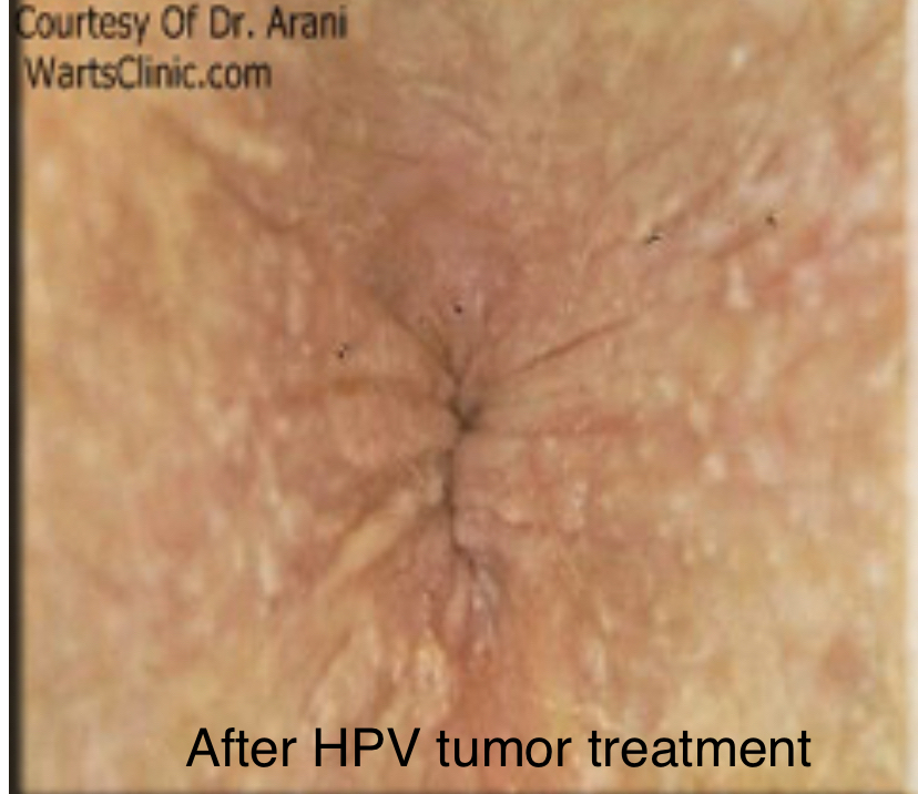 Virusul Papiloma Uman (HPV) și verucile genitale - InformatHIV