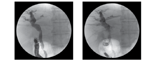 EUS Guided Procedures