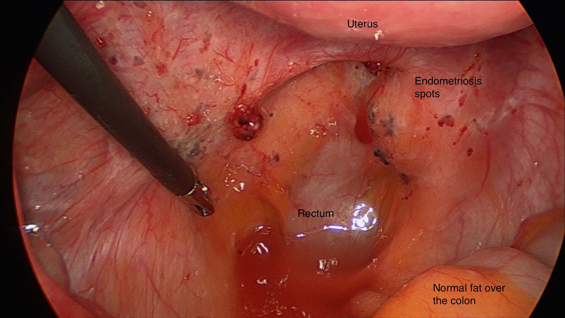 Laparoscopic Endometriosis Surgery