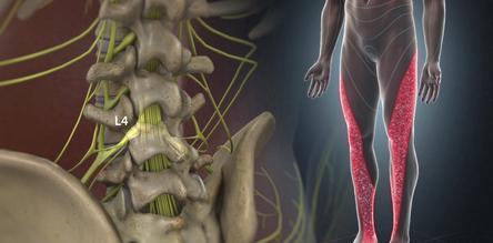 Yardley, PA - Sciatica Pain Relief by Chiropractor & Dr. Sciatic Leg Pain relief local near me in Yardley, PA