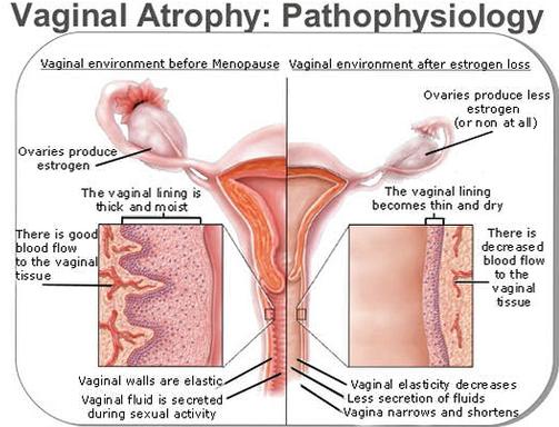 vaginal atrophy discharge