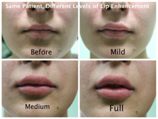 Lip Shape & Enhancement