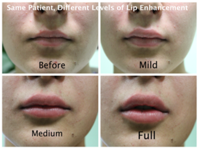 Lips Cosmetic Injectables Center