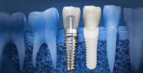 Dental Implant Clinique Implantologie Dentaire