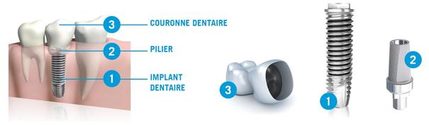 Couronne sur implant dentaire Chambly