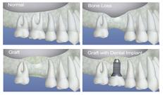 greffe osseuse-sinusale dental bone-sinus graft Brossard-Laprairie