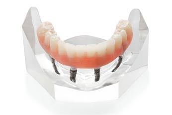 Prothèse Dentaire Fixe Sur Implants Fix-On-4 Michel Puertas Denturologiste Brossard-Laprairie, Fixed Denture On Implants Fix-On-4 Michel Puertas Denturologiste Brossard-Laprairie