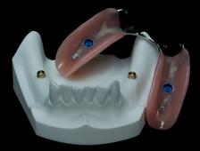 Partial Denture On Implants Clinique Implantologie Dentaire