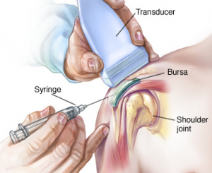 corticosteroids injections