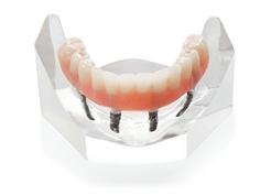 Prothèse Sur Implants Fix-On-4 Clinique Implantologie Dentaire