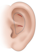 Ear cartilage harvest