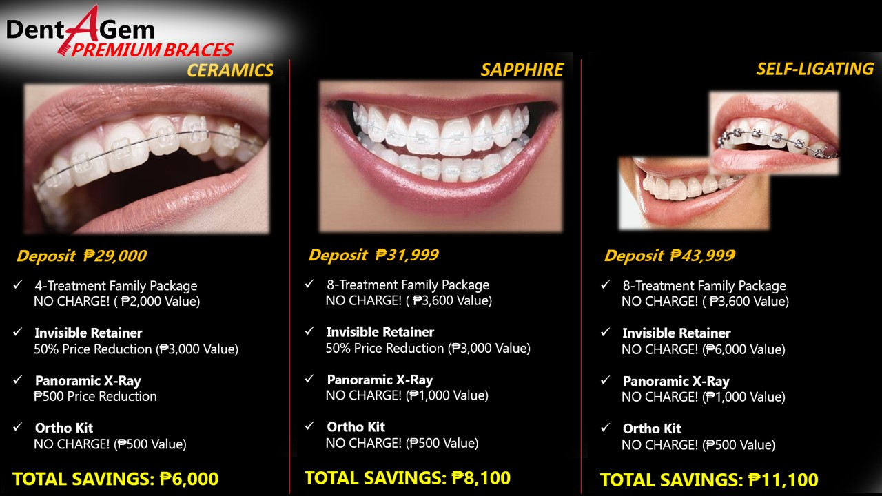 Dental Braces Deals Incl P5000 Sm Shopping Spree Choose The Price You Can Afford Orthodontics Gentle Affordable Dentist Marikina Katipunan Cubao Pasig Quezon City Metro Manila Orthodontics Dentistry