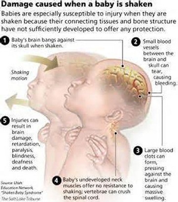 Shaken baby syndrome symptoms