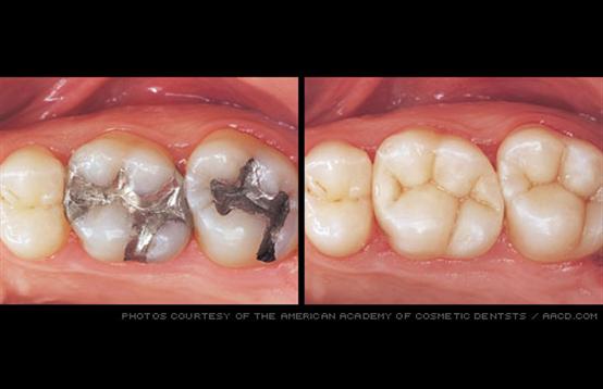 Signs a Filling Needs to be Replaced - Empire Dental