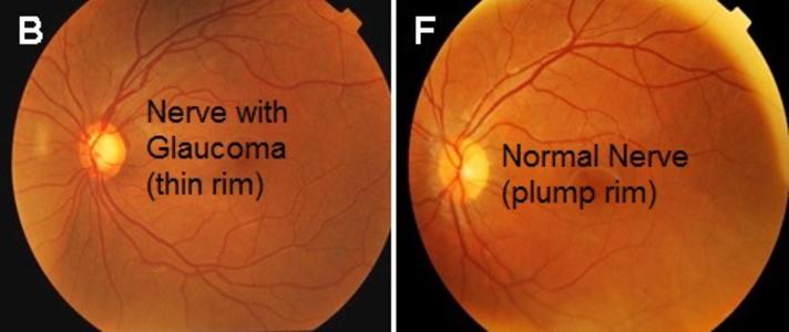 optic nerve glaucoma