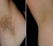 Denvers Best Laser Hair Removal and Laser Hair Removal Prices