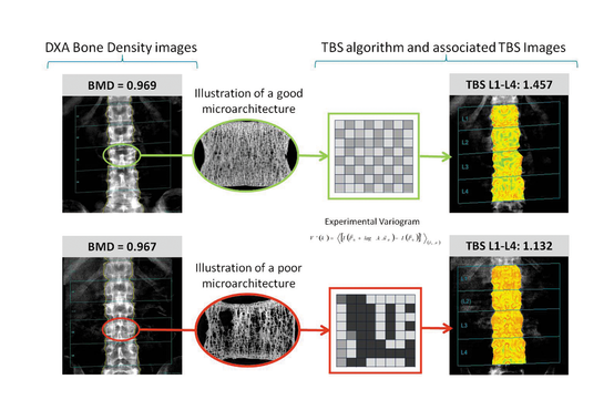 trabecular bone osteoporosis