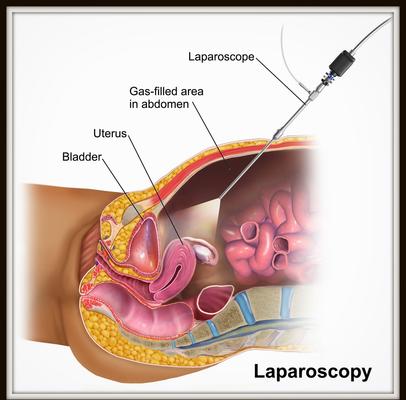 laparoscopic surgeon in goa