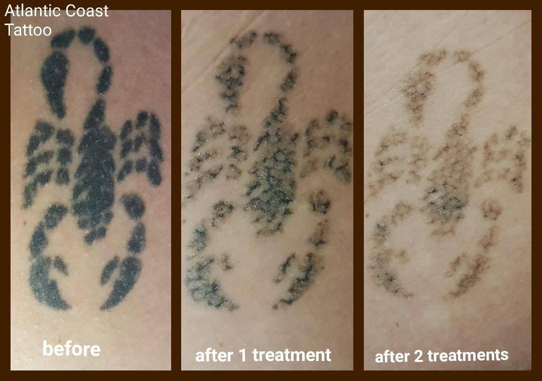 Cornwal laser tattoo removal