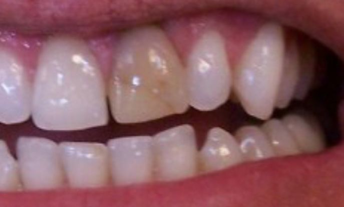 Tooth Discoloration - Dr. Joel Wallach
