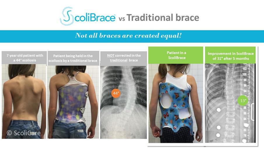 ScoliBrace custom braces treating scoliosis patients of all ages – ScoliCare