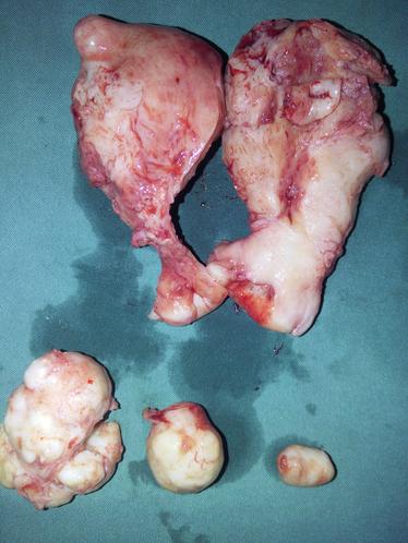 laparoscopic fibroid surgery goa