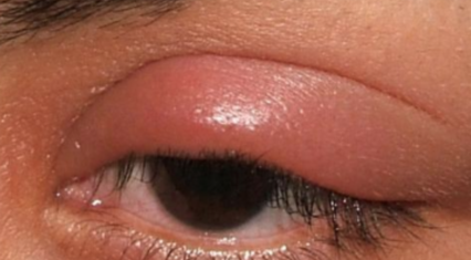 Swollen Eyelids - Dr. Joel Wallach