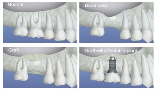 dental bone graft dental sinus graft Brossard-Laprairie