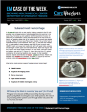 subarachnoid hemorrhage, Bansi Patel