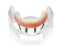 Fix-On-4 Brossard Clinique Implantologie Dentaire