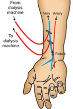 vascular hemodialysis fistula