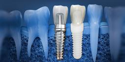 Implant Dentaire Clinique Implantologie Dentaire Brossard-Laprairie