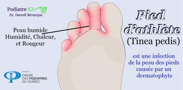 Pied d'athlète (Tinea pedis) Consultez-nous pour tous les