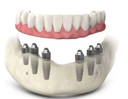 Fix-On-6 Brossard Clinique Implantologie Dentaire