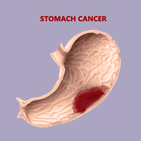 STOMACH CANCER - Risk Factors, Cancer Staging, Clinical Manifestations, Diagnostic Evaluations, Management and Prevention