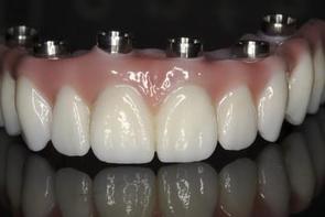 Prothèse Dentaire Fixe Zircon Sur Implants Michel Puertas Denturologiste Brossard-Laprairie, Fixed Denture On Implants Michel Puertas Denturologiste Brossard-Laprairie