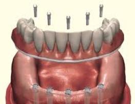 Fix-On-5 Brossard Clinique Implantologie Dentaire