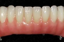 Fixed Denture Fix-On-Zircon Brossard-Laprairie