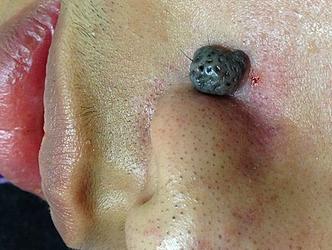 a huge black skin mole covered with large pores