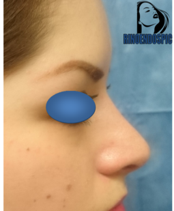 Rinoplastia después