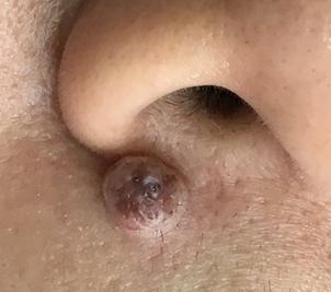 a dome-shaped light brown skin mole under right nostril