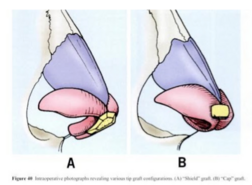 Cartilage graft rhinoplasty